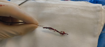 Thrombectomie